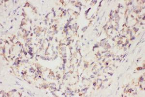 Anti-VEGF Picoband antibody,  IHC(P): Human Lung Cancer Tissue