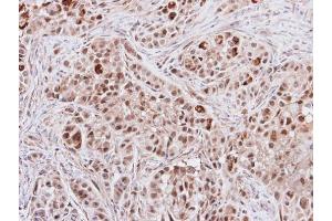 IHC-P Image Immunohistochemical analysis of paraffin-embedded A549 xenograft, using S6K2, antibody at 1:500 dilution.
