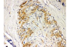 Anti- Parkin Picoband antibody, IHC(P) IHC(P): Human Intestinal Cancer Tissue
