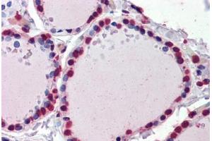 Human Thyroid (formalin-fixed, paraffin-embedded) stained with  antibody ABIN462276 followed by biotinylated secondary antibody, alkaline phosphatase-streptavidin and chromogen. (CRABP1 anticorps  (AA 1-137))