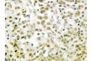 Immunohistochemistry analyzes of p53 antibody in paraffin-embedded human lung carcinoma tissue. (p53 anticorps)