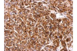 IHC-P Image SIPA1 antibody [C3], C-term detects SIPA1 protein at weak membrane and cytosol on HBL435 xenograft by immunohistochemical analysis.