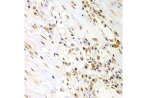 Immunohistochemistry of paraffin-embedded human gastric cancer using LHX4 antibody (ABIN5975324) at dilution of 1/100 (40x lens). (LHX4 anticorps)