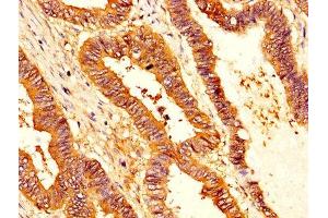IHC image of ABIN7158247 diluted at 1:200 and staining in paraffin-embedded human colon cancer performed on a Leica BondTM system.