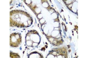 Immunohistochemistry of paraffin-embedded Human colon carcinoma using SECISBP2 Polyclonal Antibody at dilution of 1:200 (40x lens). (SECISBP2 anticorps)