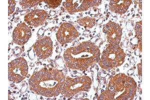 IHC-P Image Immunohistochemical analysis of paraffin-embedded human colon carcinoma, using USP8, antibody at 1:500 dilution.