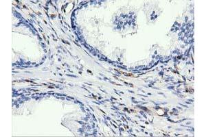 Immunohistochemical staining of paraffin-embedded Human liver tissue using anti-ARHGAP25 mouse monoclonal antibody. (ARHGAP25 anticorps)