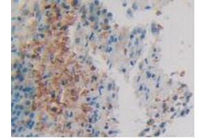 IHC-P analysis of Human Skin Cancer Tissue, with DAB staining. (Calretinin anticorps  (AA 28-248))