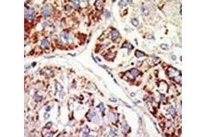 IHC analysis of FFPE human hepatocarcinoma tissue stained with the EZH1 antibody (EZH1 anticorps  (AA 393-422))