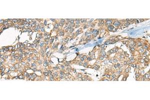 Immunohistochemistry of paraffin-embedded Human liver cancer tissue using YEATS2 Polyclonal Antibody at dilution of 1:55(x200)