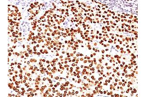 Formalin-fixed, paraffin-embedded human Breast Carcinoma stained with Progesterone Receptor Mouse Monoclonal Antibody (PR484).