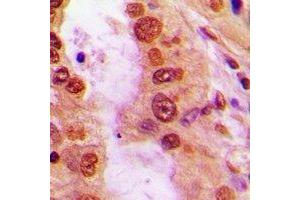 Immunohistochemical analysis of iNOS staining in human lung cancer formalin fixed paraffin embedded tissue section.