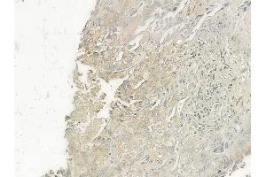 ABIN6262103 and ABIN6277371 at 1/100 staining human lung squamous cell carcinoma by IHC-P. (GRPR anticorps  (Internal Region))