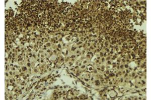 ABIN6278705 at 1/100 staining Human breast cancer tissue by IHC-P. (ZNF7 anticorps  (Internal Region))