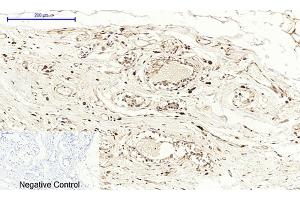 Immunohistochemical analysis of paraffin-embedded human breast tissue. (PTGS2 anticorps  (AA 530-610))
