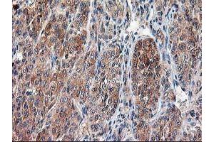 Immunohistochemical staining of paraffin-embedded Carcinoma of Human liver tissue using anti-CAPN9 mouse monoclonal antibody. (Calpain 9 anticorps)
