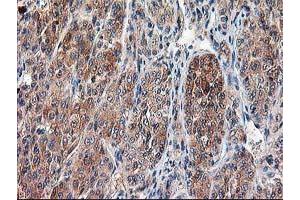 Immunohistochemical staining of paraffin-embedded Carcinoma of Human liver tissue using anti-CAPN9 mouse monoclonal antibody.