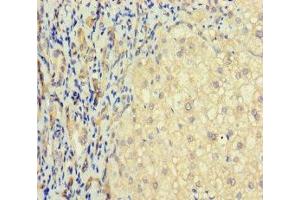 Immunohistochemistry of paraffin-embedded human liver cancer using ABIN7171548 at dilution of 1:100 (TAS2R41 anticorps  (AA 205-234))