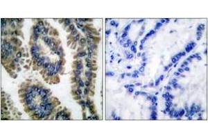 Immunohistochemistry analysis of paraffin-embedded human lung carcinoma, using STAT2 (Phospho-Tyr690) Antibody.