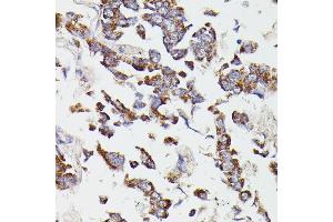 Immunohistochemistry of paraffin-embedded human lung cancer using SUCLG2 antibody  at dilution of 1:100 (40x lens).