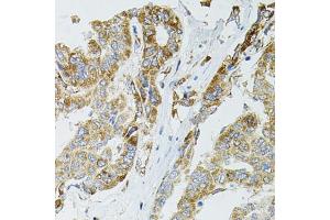 Immunohistochemistry of paraffin-embedded human liver cancer using SIRT3 antibody (ABIN5973348) at dilution of 1/100 (40x lens). (SIRT3 anticorps)
