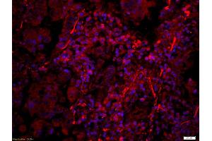 Formalin-fixed and paraffin-embedded human lung carcinoma labeled with Anti-Phospho-PERK(Thr980) Polyclonal Antibody, Unconjugated (ABIN744713) 1:200, overnight at 4°C, The secondary antibody was Goat Anti-Rabbit IgG, Cy3 conjugated used at 1:200 dilution for 40 minutes at 37°C.