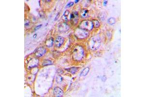 Immunohistochemical analysis of ABCB10 staining in human lung cancer formalin fixed paraffin embedded tissue section.