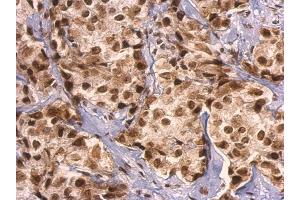 IHC-P Image GRB2 antibody detects GRB2 protein at nucleus on human breast carcinoma by immunohistochemical analysis. (GRB2 anticorps  (C-Term))