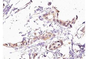 ABIN6276589 at 1/100 staining Human breast cancer tissue by IHC-P.