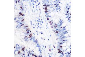 Immunohistochemistry of paraffin-embedded human colon carcinoma using GMNN Rabbit pAb (ABIN6129382, ABIN6141186, ABIN6141187 and ABIN6220942) at dilution of 1:100 (40x lens).