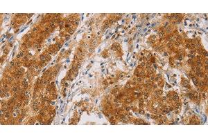 Immunohistochemistry of paraffin-embedded Human gasrtic cancer tissue using CENPE Polyclonal Antibody at dilution 1:50 (CENPE anticorps)