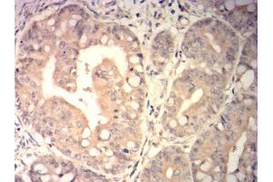 Immunohistochemical analysis of paraffin-embedded rectal cancer tissues using SP17 mouse mAb with DAB staining.
