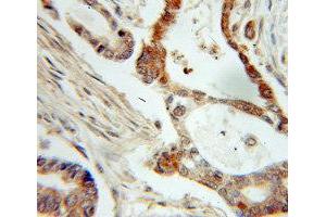 Immunohistochemistry of paraffin-embedded Pancreas cancer using NME1 antibody. (NME1 anticorps  (C-Term))