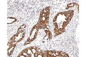 Immunohistochemistry analysis of paraffin-embedded human stomach cancer using CK-8 Polyclonal Antibody at dilution of 1:200. (KRT8 anticorps)