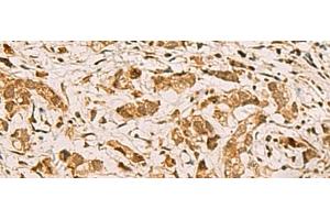 Immunohistochemistry of paraffin-embedded Human gastric cancer tissue using ZMAT4 Polyclonal Antibody at dilution of 1:65(x200) (ZMAT4 anticorps)