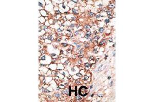 Formalin-fixed and paraffin-embedded human hepatocellular carcinoma tissue reacted with GJA9 polyclonal antibody  , which was peroxidase-conjugated to the secondary antibody, followed by AEC staining. (GJA9 anticorps  (C-Term))