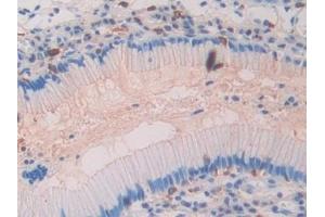 Detection of CD63 in Human Stomach cancer Tissue using Polyclonal Antibody to Tetraspanin 30Cluster of Differentiation 63 (CD63)
