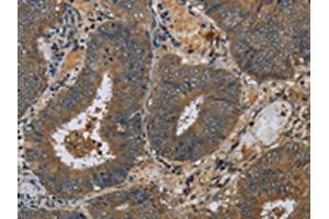 The image on the left is immunohistochemistry of paraffin-embedded Human colon cancer tissue using ABIN7130524(PAEP Antibody) at dilution 1/60, on the right is treated with fusion protein. (PAEP anticorps)