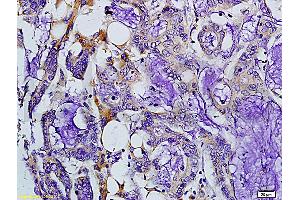 Formalin-fixed and paraffin embedded human colon carcinoma labeled with Rabbit Anti-MMP-7 Polyclonal Antibody, Unconjugated (ABIN668451) at 1:200 followed by conjugation to the secondary antibody and DAB staining. (MMP7 anticorps  (AA 151-250))
