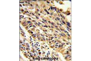 Formalin-fixed and paraffin-embedded human lung carcinoma reacted with TRIP13 Antibody , which was peroxidase-conjugated to the secondary antibody, followed by DAB staining. (TRIP13 anticorps  (N-Term))
