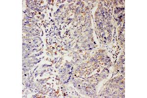 Anti-SLC9A2 antibody, IHC(P) IHC(P): Human Lung Cancer Tissue (SLC9A2 anticorps  (C-Term))