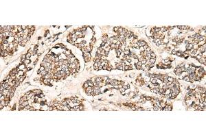 Immunohistochemistry of paraffin-embedded Human esophagus cancer tissue using C1S Polyclonal Antibody at dilution of 1:55(x200) (C1S anticorps)