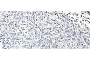 Immunohistochemistry of paraffin-embedded Human lung cancer tissue using RERG Polyclonal Antibody at dilution of 1:65(x200) (RERG anticorps)