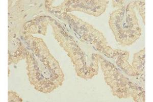 Immunohistochemistry of paraffin-embedded human prostate cancer using ABIN7164612 at dilution of 1:100 (OSGEPL1 anticorps  (AA 1-270))
