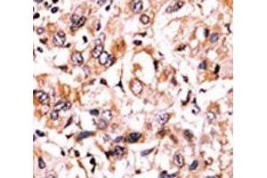 IHC analysis of FFPE human hepatocarcinoma tissue stained with the phospho-Wee1 antibody. (WEE1 anticorps  (pSer123))