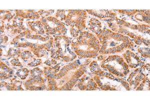 Immunohistochemistry of paraffin-embedded Human thyroid cancer tissue using TRPV4 Polyclonal Antibody at dilution 1:40 (TRPV4 anticorps)