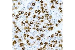 Immunohistochemical analysis of TPPP3 staining in human gastric cancer formalin fixed paraffin embedded tissue section. (TPPP3 anticorps)