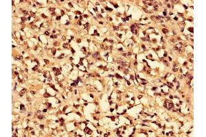 Immunohistochemistry of paraffin-embedded human melanoma using ABIN7146698 at dilution of 1:100