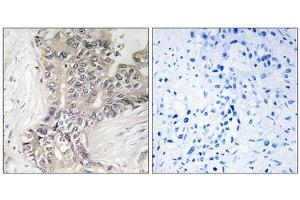 Immunohistochemistry analysis of paraffin-embedded human liver carcinoma tissue using B3GALTL antibody. (B3GALTL anticorps  (C-Term))