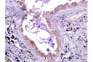 Formalin-fixed and paraffin embedded human lung carcinoma labeled with Anti-LAG-3/CD223 Polyclonal Antibody, Unconjugated (ABIN748508) at 1:200 followed by conjugation to the secondary antibody and DAB staining (LAG3 anticorps  (AA 201-300))